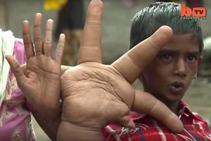 Врачи уменьшили индийскому мальчику гигантскую руку